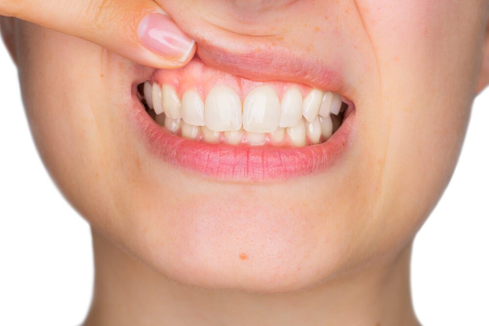 Diş Eti Çekilmesi Kendi Kendine Geçer mi? Belirtiler ve Hatalar