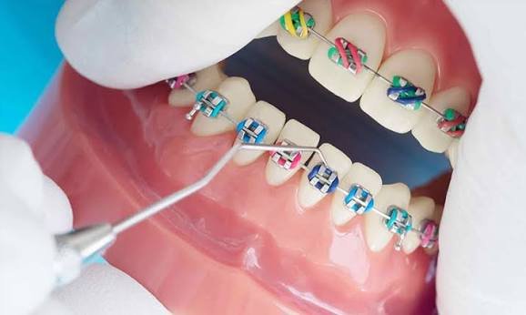 Orthodontic treatment planning